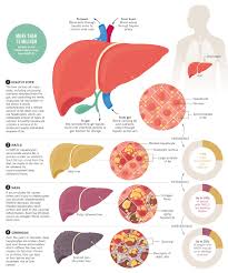 Why fatty liver is dangerous?