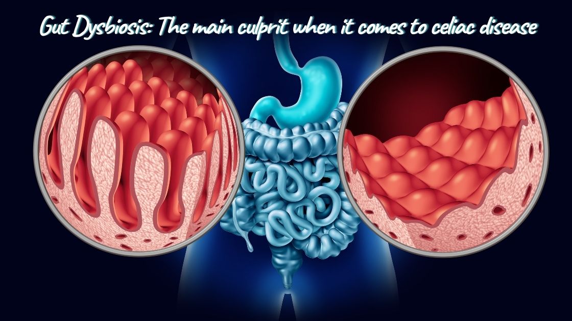 Gut Dysbiosis: The main culprit for causing celiac disease