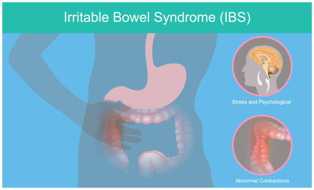 All about Irritable Bowel Syndrome(IBS)